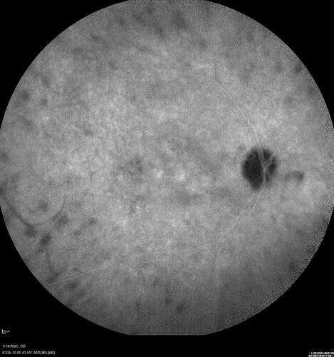 Birdshot Chorioretinitis - Chronic Untreated with Drusen Like Material in Macula
72 year old female with vision changes for years just now diagnosed with Birdshot.
