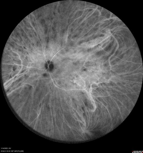 Birdshot Chorioretinitis - Chronic Untreated with Drusen Like Material in Macula
72 year old female with vision changes for years just now diagnosed with Birdshot.
