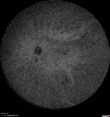 Birdshot Chorioretinitis - Chronic Untreated with Drusen Like Material in Macula
72 year old female with vision changes for years just now diagnosed with Birdshot.
