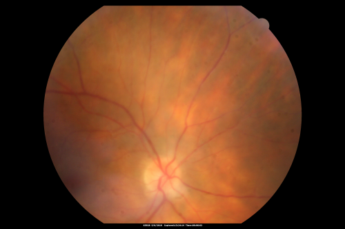 Birdshot Chorioretinitis - Retinal Vasculitis - HLA A29 Positive 
64-year-old woman three or four yearâ€™s fluctuations in her vision.  She mostly notices them in bright light her vision glares out and she has difficulty seeing. PMHx: malaria in 1948 that was treated.  She was told at one point she could possibly have had Familial Mediterranean fever. 

She does intermittently get rashes around her arms.  She has arthritis in her knees and ankles.  
VISUAL ACUITY:  OD 20/40,  OS 20/50 -  HLA - A29 Positive
