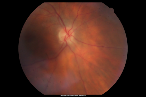Birdshot Chorioretinitis - Retinal Vasculitis - HLA A29 Positive 
64-year-old woman three or four yearâ€™s fluctuations in her vision.  She mostly notices them in bright light her vision glares out and she has difficulty seeing. PMHx: malaria in 1948 that was treated.  She was told at one point she could possibly have had Familial Mediterranean fever. 

She does intermittently get rashes around her arms.  She has arthritis in her knees and ankles.  
VISUAL ACUITY:  OD 20/40,  OS 20/50 -  HLA - A29 Positive
