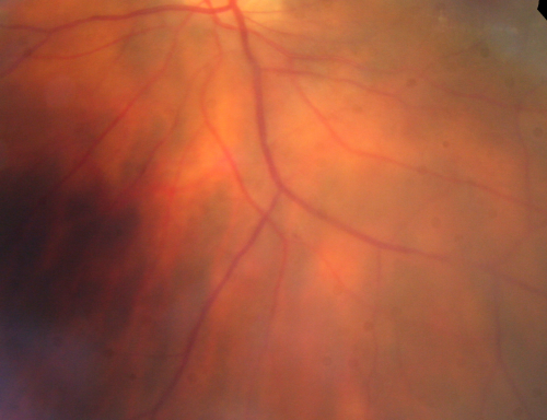 Birdshot Chorioretinitis - Retinal Vasculitis - HLA A29 Positive 
64-year-old woman three or four yearâ€™s fluctuations in her vision.  She mostly notices them in bright light her vision glares out and she has difficulty seeing. PMHx: malaria in 1948 that was treated.  She was told at one point she could possibly have had Familial Mediterranean fever. 

She does intermittently get rashes around her arms.  She has arthritis in her knees and ankles.  
VISUAL ACUITY:  OD 20/40,  OS 20/50 -  HLA - A29 Positive
