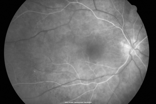 Birdshot Chorioretinitis - Retinal Vasculitis - HLA A29 Positive 
64-year-old woman three or four yearâ€™s fluctuations in her vision.  She mostly notices them in bright light her vision glares out and she has difficulty seeing. PMHx: malaria in 1948 that was treated.  She was told at one point she could possibly have had Familial Mediterranean fever. 

She does intermittently get rashes around her arms.  She has arthritis in her knees and ankles.  
VISUAL ACUITY:  OD 20/40,  OS 20/50 -  HLA - A29 Positive
