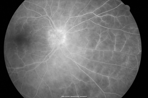 Birdshot Chorioretinitis - Retinal Vasculitis - HLA A29 Positive 
64-year-old woman three or four yearâ€™s fluctuations in her vision.  She mostly notices them in bright light her vision glares out and she has difficulty seeing. PMHx: malaria in 1948 that was treated.  She was told at one point she could possibly have had Familial Mediterranean fever. 

She does intermittently get rashes around her arms.  She has arthritis in her knees and ankles.  
VISUAL ACUITY:  OD 20/40,  OS 20/50 -  HLA - A29 Positive
