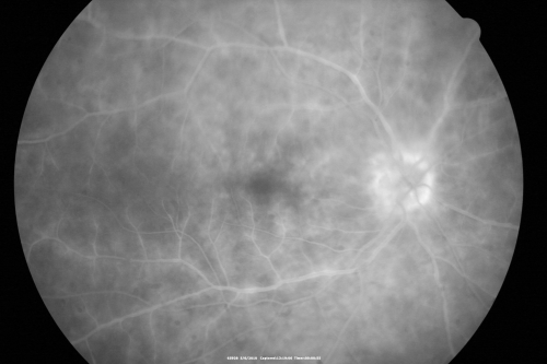 Birdshot Chorioretinitis - Retinal Vasculitis - HLA A29 Positive 
64-year-old woman three or four yearâ€™s fluctuations in her vision.  She mostly notices them in bright light her vision glares out and she has difficulty seeing. PMHx: malaria in 1948 that was treated.  She was told at one point she could possibly have had Familial Mediterranean fever. 

She does intermittently get rashes around her arms.  She has arthritis in her knees and ankles.  
VISUAL ACUITY:  OD 20/40,  OS 20/50 -  HLA - A29 Positive
