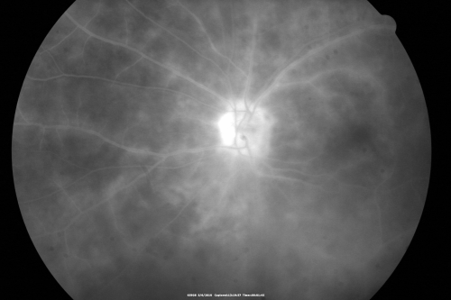 Birdshot Chorioretinitis - Retinal Vasculitis - HLA A29 Positive 
64-year-old woman three or four yearâ€™s fluctuations in her vision.  She mostly notices them in bright light her vision glares out and she has difficulty seeing. PMHx: malaria in 1948 that was treated.  She was told at one point she could possibly have had Familial Mediterranean fever. 

She does intermittently get rashes around her arms.  She has arthritis in her knees and ankles.  
VISUAL ACUITY:  OD 20/40,  OS 20/50 -  HLA - A29 Positive
