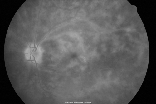 Birdshot Chorioretinitis - Retinal Vasculitis - HLA A29 Positive 
64-year-old woman three or four yearâ€™s fluctuations in her vision.  She mostly notices them in bright light her vision glares out and she has difficulty seeing. PMHx: malaria in 1948 that was treated.  She was told at one point she could possibly have had Familial Mediterranean fever. 

She does intermittently get rashes around her arms.  She has arthritis in her knees and ankles.  
VISUAL ACUITY:  OD 20/40,  OS 20/50 -  HLA - A29 Positive
