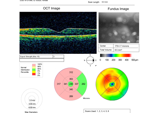 Birdshot Chorioretinitis - Retinal Vasculitis - HLA A29 Positive 
64-year-old woman three or four yearâ€™s fluctuations in her vision.  She mostly notices them in bright light her vision glares out and she has difficulty seeing. PMHx: malaria in 1948 that was treated.  She was told at one point she could possibly have had Familial Mediterranean fever. 

She does intermittently get rashes around her arms.  She has arthritis in her knees and ankles.  
VISUAL ACUITY:  OD 20/40,  OS 20/50 -  HLA - A29 Positive
