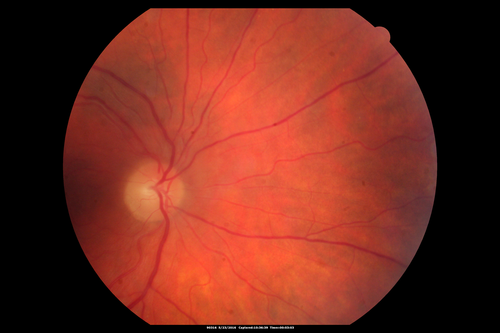 Birdshot Chorioretinitis - Fresh Presentation
Ultawidefield ICG shows best the multifocal lesions.  61 year old woman with floaters for less than 6 months.  HLA-A29 Positive
