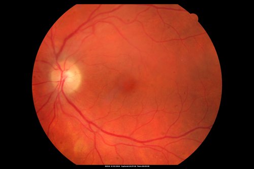 Birdshot Chorioretinitis - Fresh Presentation
Ultawidefield ICG shows best the multifocal lesions.  61 year old woman with floaters for less than 6 months.  HLA-A29 Positive
