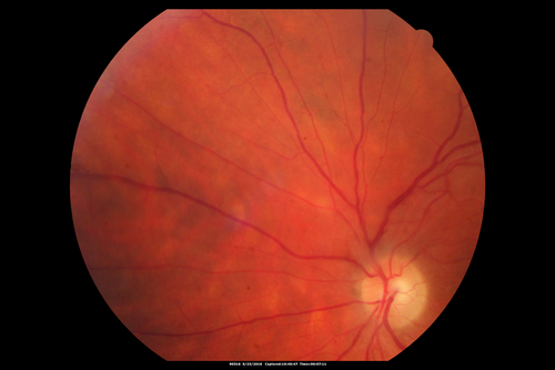 Birdshot Chorioretinitis - Fresh Presentation
Ultawidefield ICG shows best the multifocal lesions.  61 year old woman with floaters for less than 6 months.  HLA-A29 Positive
