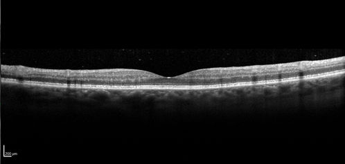 Birdshot Chorioretinitis - Fresh Presentation
Ultawidefield ICG shows best the multifocal lesions.  61 year old woman with floaters for less than 6 months.  HLA-A29 Positive

