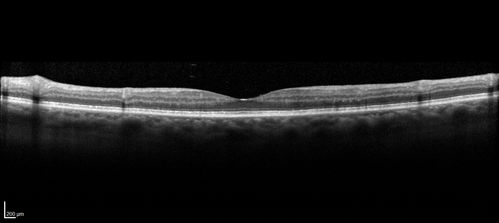 Birdshot Chorioretinitis - Fresh Presentation
Ultawidefield ICG shows best the multifocal lesions.  61 year old woman with floaters for less than 6 months.  HLA-A29 Positive
