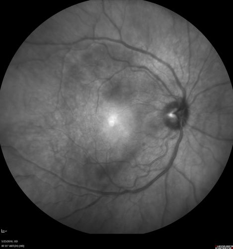 Birdshot Chorioretinitis - Fresh Presentation
Ultawidefield ICG shows best the multifocal lesions.  61 year old woman with floaters for less than 6 months.  HLA-A29 Positive
