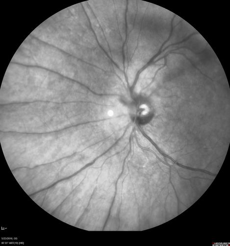 Birdshot Chorioretinitis - Fresh Presentation
Ultawidefield ICG shows best the multifocal lesions.  61 year old woman with floaters for less than 6 months.  HLA-A29 Positive
