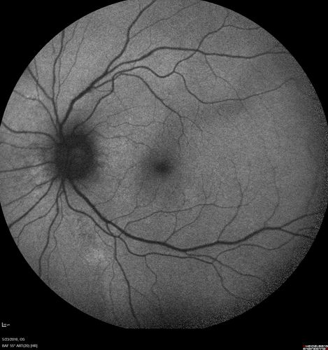 Birdshot Chorioretinitis - Fresh Presentation
Ultawidefield ICG shows best the multifocal lesions.  61 year old woman with floaters for less than 6 months.  HLA-A29 Positive
