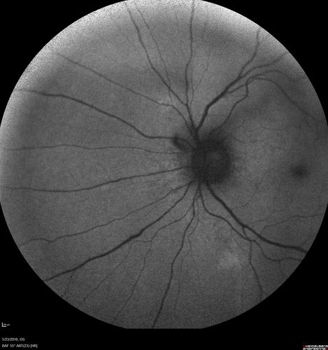 Birdshot Chorioretinitis - Fresh Presentation
Ultawidefield ICG shows best the multifocal lesions.  61 year old woman with floaters for less than 6 months.  HLA-A29 Positive
