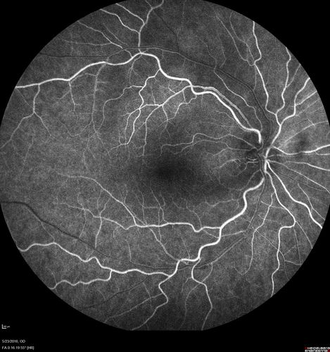 Birdshot Chorioretinitis - Fresh Presentation
Ultawidefield ICG shows best the multifocal lesions.  61 year old woman with floaters for less than 6 months.  HLA-A29 Positive
