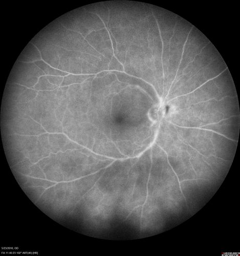 Birdshot Chorioretinitis - Fresh Presentation
Ultawidefield ICG shows best the multifocal lesions.  61 year old woman with floaters for less than 6 months.  HLA-A29 Positive
