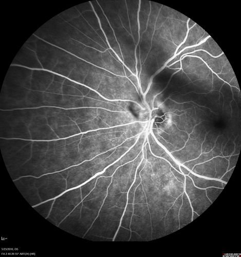 Birdshot Chorioretinitis - Fresh Presentation
Ultawidefield ICG shows best the multifocal lesions.  61 year old woman with floaters for less than 6 months.  HLA-A29 Positive
