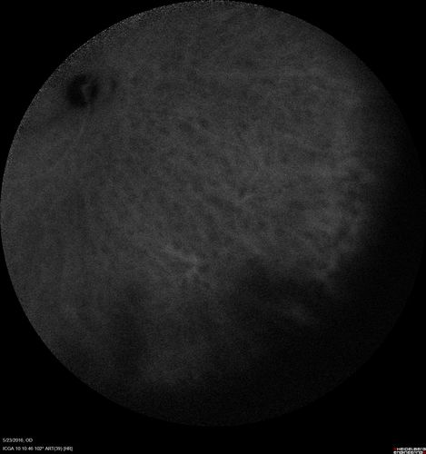 Birdshot Chorioretinitis - Fresh Presentation
Ultawidefield ICG shows best the multifocal lesions.  61 year old woman with floaters for less than 6 months.  HLA-A29 Positive
