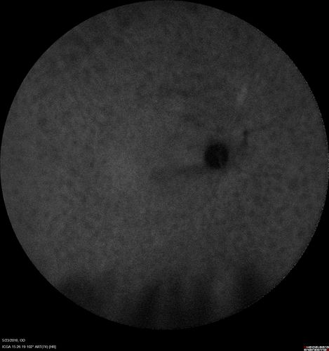 Birdshot Chorioretinitis - Fresh Presentation
Ultawidefield ICG shows best the multifocal lesions.  61 year old woman with floaters for less than 6 months.  HLA-A29 Positive
