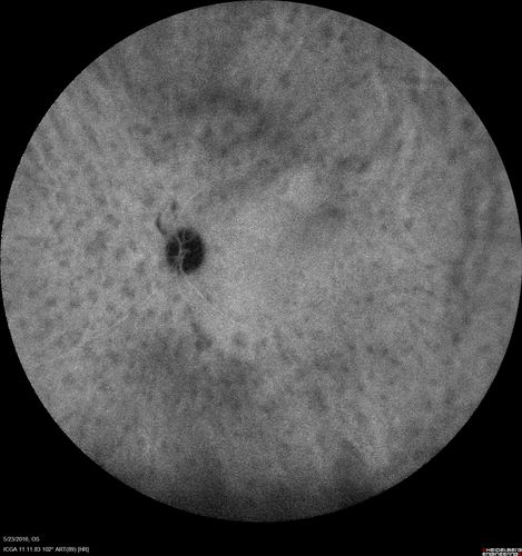 Birdshot Chorioretinitis - Fresh Presentation
Ultawidefield ICG shows best the multifocal lesions.  61 year old woman with floaters for less than 6 months.  HLA-A29 Positive
