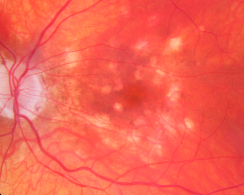 Atypical Birdshot Chorioretinitis and Retinal Arterial Macroaneurysm Right Eye - HLA-B29 Positive
55-year-old woman has multifocal choroiditis in both eyes because she was HLA A-29 positive.  She has presumptive birdshot chorioretinopathy.  She has not noticed any vision changes.  OD 20/40, OS 20/20.
