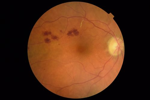 Chronic BRAO with Hemorrhages  - Sclerosed Vessel
95 year old female with blurred vision in both eyes in for a checkup.  History of perpapillary CNVM in the left eye 2 years prior not treated. History of stroke with multiple emboli 1 year ago.
Vision 20/32 OD, 20/40 OS
