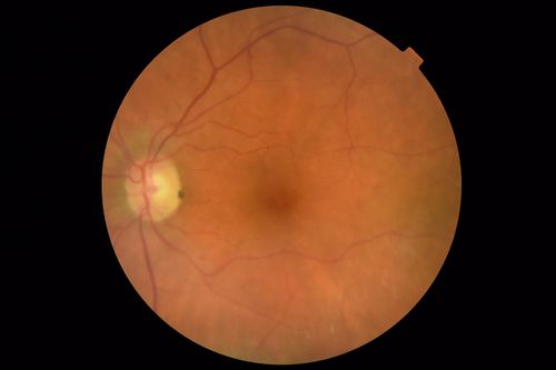 Chronic BRAO with Hemorrhages  - Sclerosed Vessel
95 year old female with blurred vision in both eyes in for a checkup.  History of perpapillary CNVM in the left eye 2 years prior not treated. History of stroke with multiple emboli 1 year ago.
Vision 20/32 OD, 20/40 OS
