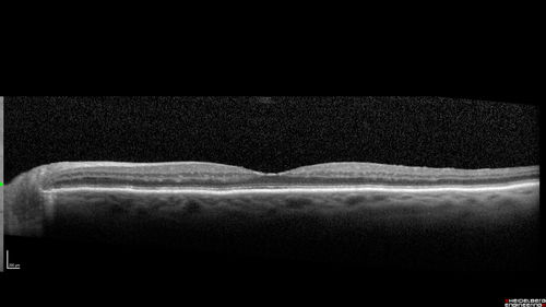 Chronic BRAO with Hemorrhages  - Sclerosed Vessel
95 year old female with blurred vision in both eyes in for a checkup.  History of perpapillary CNVM in the left eye 2 years prior not treated. History of stroke with multiple emboli 1 year ago.
Vision 20/32 OD, 20/40 OS
