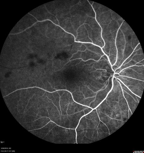 Chronic BRAO with Hemorrhages  - Sclerosed Vessel
95 year old female with blurred vision in both eyes in for a checkup.  History of perpapillary CNVM in the left eye 2 years prior not treated. History of stroke with multiple emboli 1 year ago.
Vision 20/32 OD, 20/40 OS
