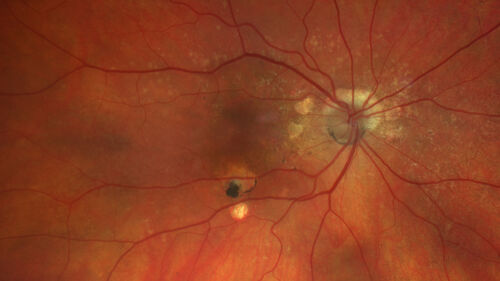 Fresh BRAO in patient with wet AMD
91 year old female  She noticed last night a shadow over the left eye. When she closes her right eye she cannot see the bottom of the vision in the left eye. This is new.
VA OD: sc20/32-1
VA OS: sc20/32-2
