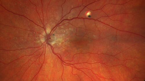Fresh BRAO in patient with wet AMD
91 year old female  She noticed last night a shadow over the left eye. When she closes her right eye she cannot see the bottom of the vision in the left eye. This is new.
VA OD: sc20/32-1
VA OS: sc20/32-2
