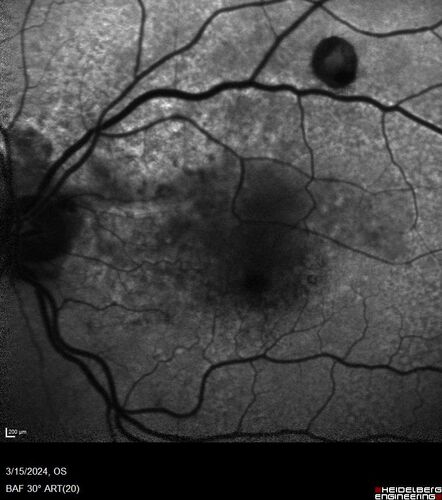 Fresh BRAO in patient with wet AMD
91 year old female  She noticed last night a shadow over the left eye. When she closes her right eye she cannot see the bottom of the vision in the left eye. This is new.
VA OD: sc20/32-1
VA OS: sc20/32-2
