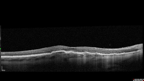 Fresh BRAO in patient with wet AMD
91 year old female  She noticed last night a shadow over the left eye. When she closes her right eye she cannot see the bottom of the vision in the left eye. This is new.
VA OD: sc20/32-1
VA OS: sc20/32-2

