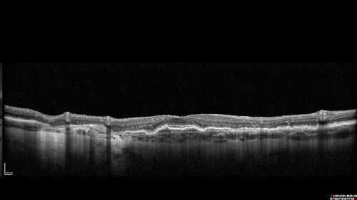 Fresh BRAO in patient with wet AMD
91 year old female  She noticed last night a shadow over the left eye. When she closes her right eye she cannot see the bottom of the vision in the left eye. This is new.
VA OD: sc20/32-1
VA OS: sc20/32-2
