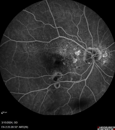 Fresh BRAO in patient with wet AMD
91 year old female  She noticed last night a shadow over the left eye. When she closes her right eye she cannot see the bottom of the vision in the left eye. This is new.
VA OD: sc20/32-1
VA OS: sc20/32-2
