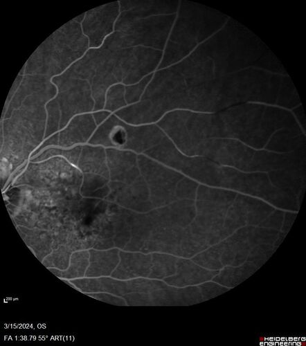 Fresh BRAO in patient with wet AMD
91 year old female  She noticed last night a shadow over the left eye. When she closes her right eye she cannot see the bottom of the vision in the left eye. This is new.
VA OD: sc20/32-1
VA OS: sc20/32-2
