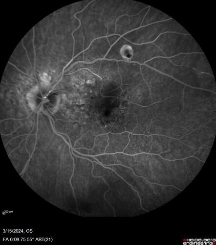 Fresh BRAO in patient with wet AMD
91 year old female  She noticed last night a shadow over the left eye. When she closes her right eye she cannot see the bottom of the vision in the left eye. This is new.
VA OD: sc20/32-1
VA OS: sc20/32-2
