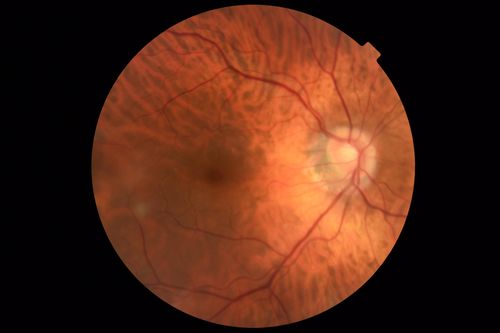 Branch Retinal Artery Occlusion - No Plaque
74 year old man with 2 days of vision loss.  Vision OS is 20/200 but improved to 20/25 in 1 month.  He has dysfibrinogen anemia.
