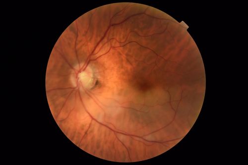 Branch Retinal Artery Occlusion - No Plaque
74 year old man with 2 days of vision loss.  Vision OS is 20/200 but improved to 20/25 in 1 month.  He has dysfibrinogen anemia.
