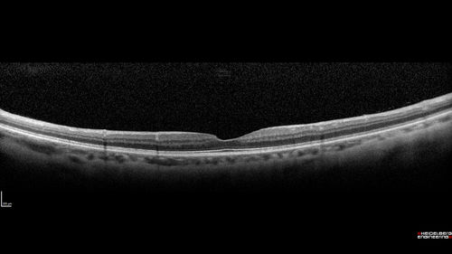 Branch Retinal Artery Occlusion - No Plaque
74 year old man with 2 days of vision loss.  Vision OS is 20/200 but improved to 20/25 in 1 month.  He has dysfibrinogen anemia.
