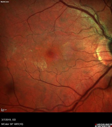 Branch Retinal Artery Occlusion - No Plaque
74 year old man with 2 days of vision loss.  Vision OS is 20/200 but improved to 20/25 in 1 month.  He has dysfibrinogen anemia.
