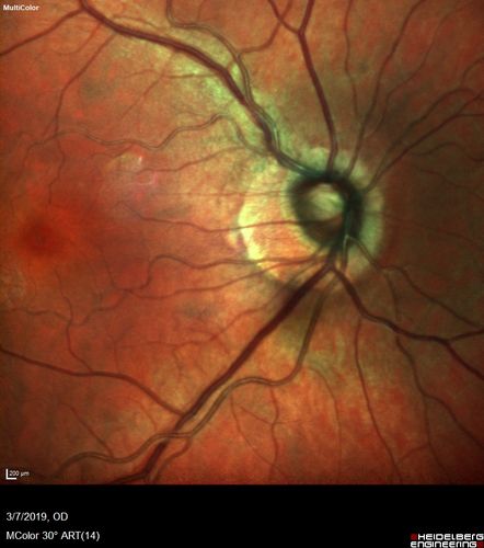 Branch Retinal Artery Occlusion - No Plaque
74 year old man with 2 days of vision loss.  Vision OS is 20/200 but improved to 20/25 in 1 month.  He has dysfibrinogen anemia.
