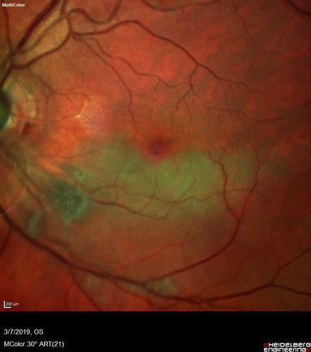 Branch Retinal Artery Occlusion - No Plaque
74 year old man with 2 days of vision loss.  Vision OS is 20/200 but improved to 20/25 in 1 month.  He has dysfibrinogen anemia.
