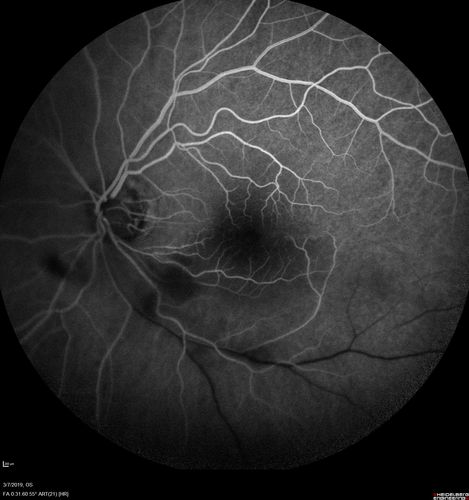 Branch Retinal Artery Occlusion - No Plaque
74 year old man with 2 days of vision loss.  Vision OS is 20/200 but improved to 20/25 in 1 month.  He has dysfibrinogen anemia.

