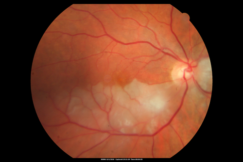 Branch Retinal Artery Occlusion
Acute Inferotemporal Occlusion Right Eye - FA shows delayed circulation, OCT shows edema of superficial layers of retina

