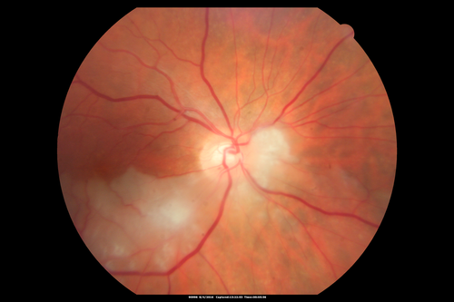 Branch Retinal Artery Occlusion
Acute Inferotemporal Occlusion Right Eye - FA shows delayed circulation, OCT shows edema of superficial layers of retina
