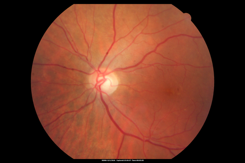 Branch Retinal Artery Occlusion
Acute Inferotemporal Occlusion Right Eye - FA shows delayed circulation, OCT shows edema of superficial layers of retina
